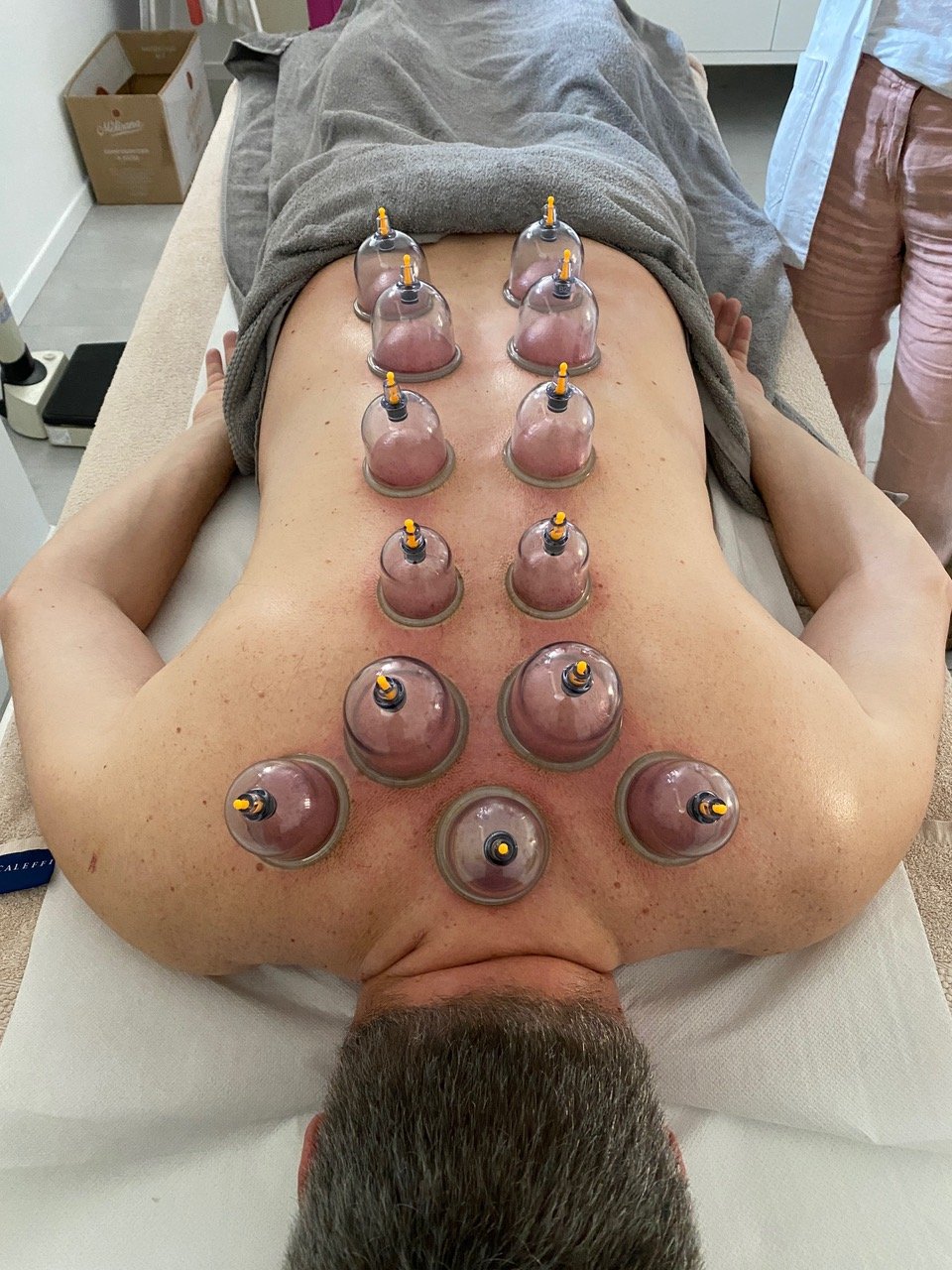 Coppettazione e cupping massage sulla schiena nello studio di Pordenone